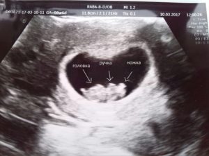 Замершая беременность в 12 недель