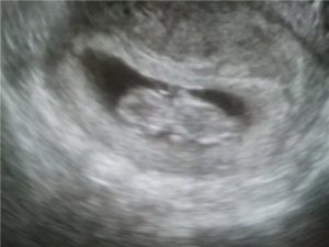6 Недель зачатия ктр