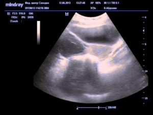 Угроза выкидыша 3 неделе беременности