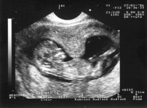 Беременность 12 недель гипертонус