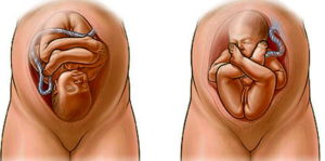 Тазовое предлежание плода на 38 неделе беременности