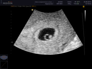 У кого 5 неделя беременности