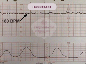 Тахикардия у плода 33 недели