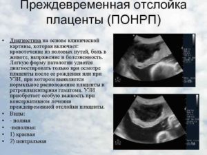 Отслойка плаценты 16 неделе беременности