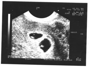 Узи 7 недель беременность двойня