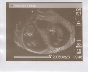 11 12 Недель беременности двойня