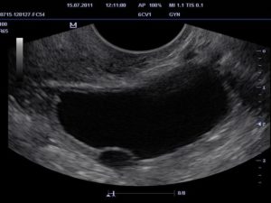 5 Недель беременности тянет правый яичник