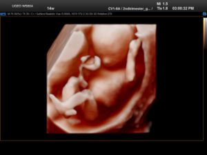 3d узи 14 недель