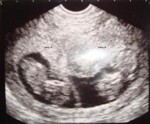 Беременность 10 недель двойня