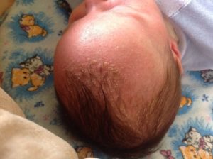 Корочка на голове новорожденного ребенка