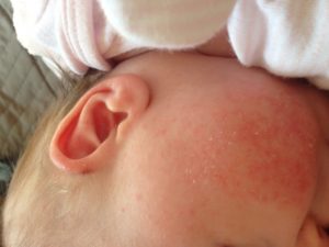Как лечить прыщики у новорожденного на лице?