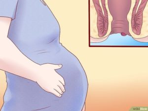 Геморрой на 39 неделе беременности лечение