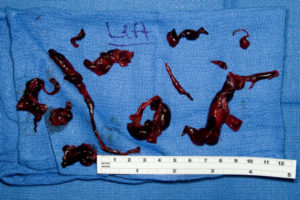 4 Недели беременности капля крови