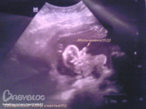 Тонус матки на 22 неделе