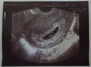 6 Неделя беременности видно узи