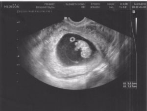 Срок беременности 8 9 недель