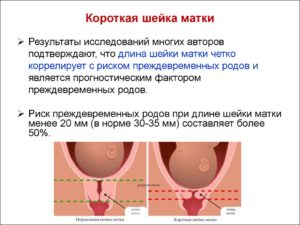 Короткая шейка матки 23 недели