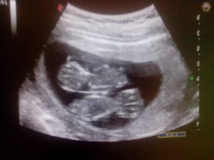 29 Недель беременности двойня параметры