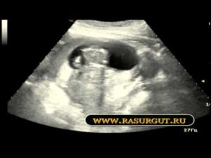 Гематома 11 неделе беременности