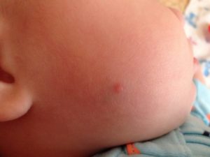 У новорожденного красные прыщи