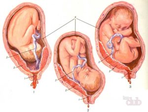 Низкое расположение плаценты при беременности 12 недель