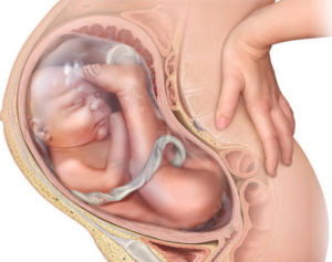 Тазовое предлежание плода на 38 неделе беременности