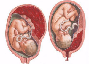 Отслойка плаценты на 40 неделе беременности