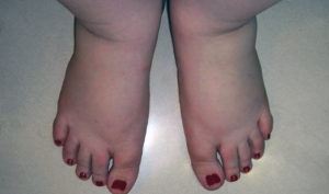 Отекают ноги на 29 неделе беременности