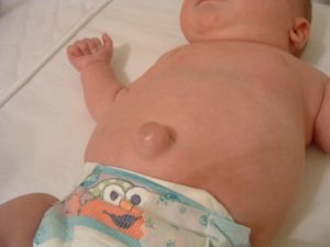 Как лечить грыжу пупка у новорожденных?