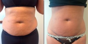 Ультразвуковая кавитация побочные эффекты