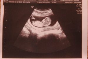 Первый скрининг 12 недель беременности