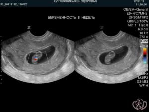 Беременность 7 8 недель развитие