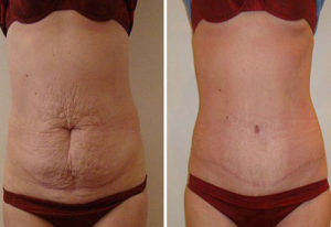 Дряблый живот после родов как убрать отзывы