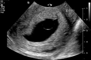 Угроза выкидыша 3 неделе беременности