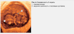 Пропали признаки беременности на 8 неделе