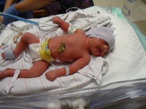 Ребенок родившийся в 33 недели