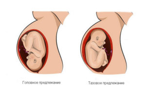 Головное предлежание плода при беременности 21 неделя