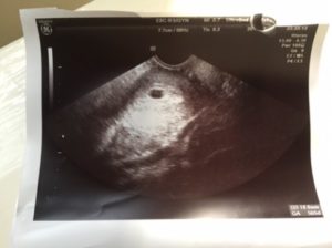 3 Неделя беременности кровит