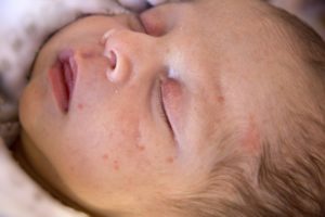 Прыщи на лице у новорожденного чем лечить