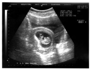 Внематочная беременность 9 неделе