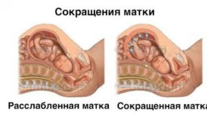 Тонус матки на 26 неделе беременности симптомы