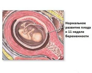 11 Недель беременности сильный токсикоз