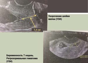 Гематома 11 неделе беременности