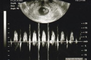 Сердцебиение эмбриона в 8 недель