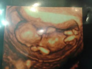 Тонус матки на 22 неделе