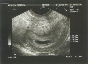 Угроза выкидыша 3 неделе беременности