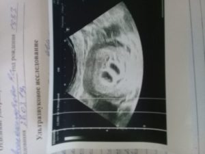 29 Недель беременности двойня параметры