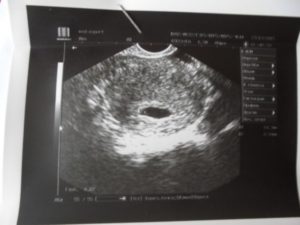 Не видно эмбрион 7 8 акушерских недель