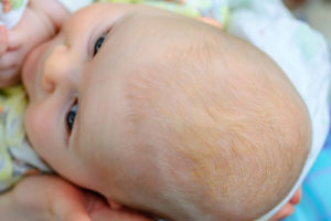 Как убрать корочки у новорожденного на голове?