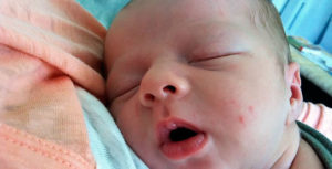 У новорожденного красные прыщи